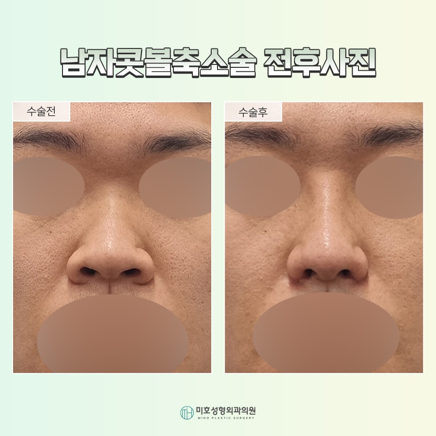 A Successful Guide to Male Alar Reduction for a Refined Appearance image 7