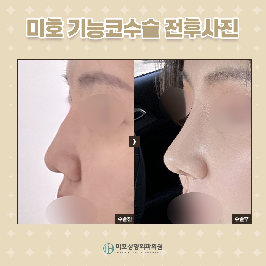 While Adjusting the Shape During Nasal Valve Reconstruction image 8
