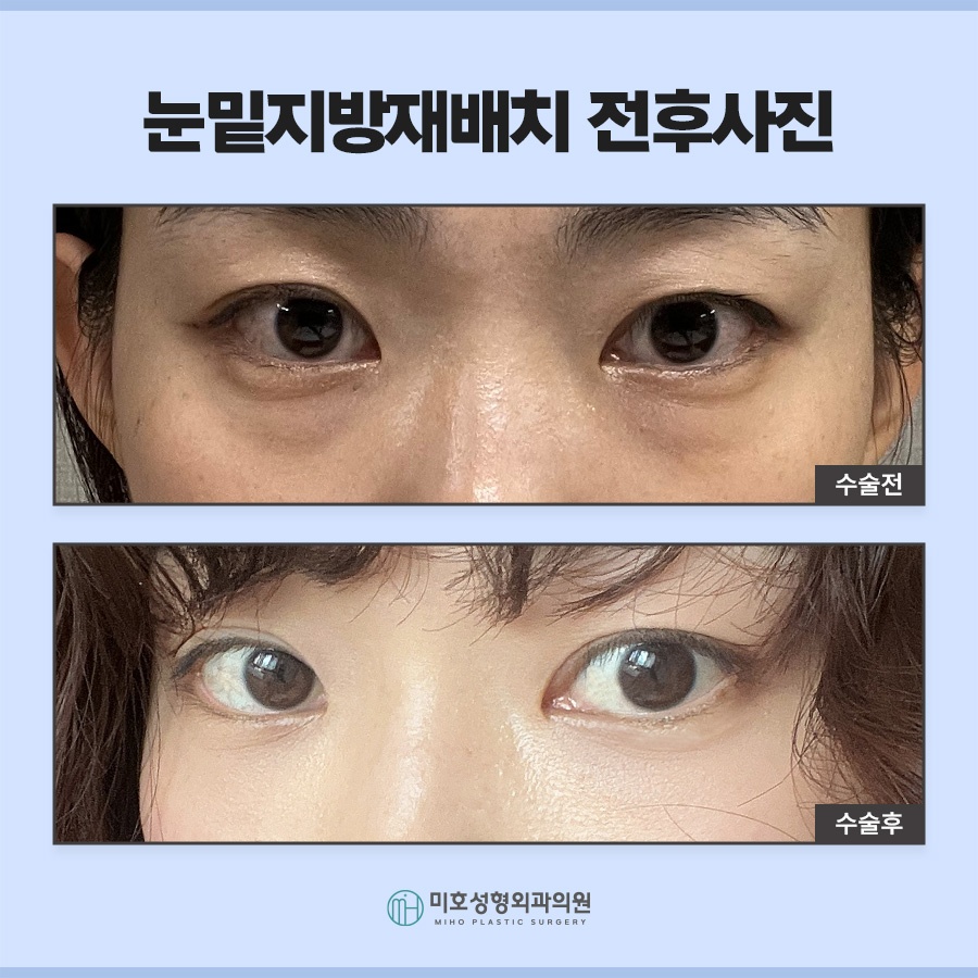 눈밑지 다크서클 처짐 고민된다면 관련 이미지 9
