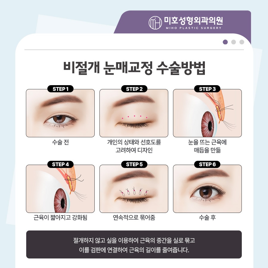Focusing on a Natural Look in Male Eye Surgery image 5