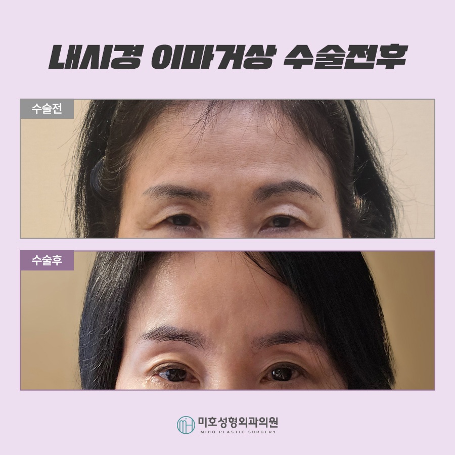 Forehead Lift Surgery Review: Tailored to Sagging Areas image 9