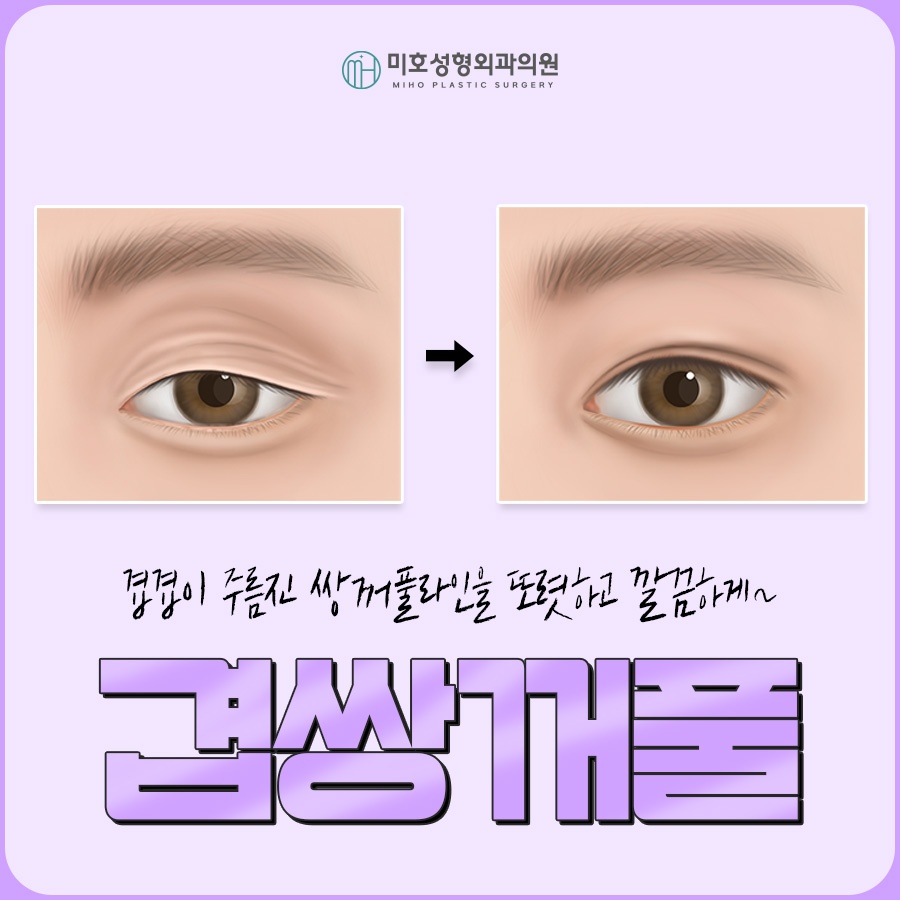 A Clean, Smooth Line for Double Eyelid Folds image 1