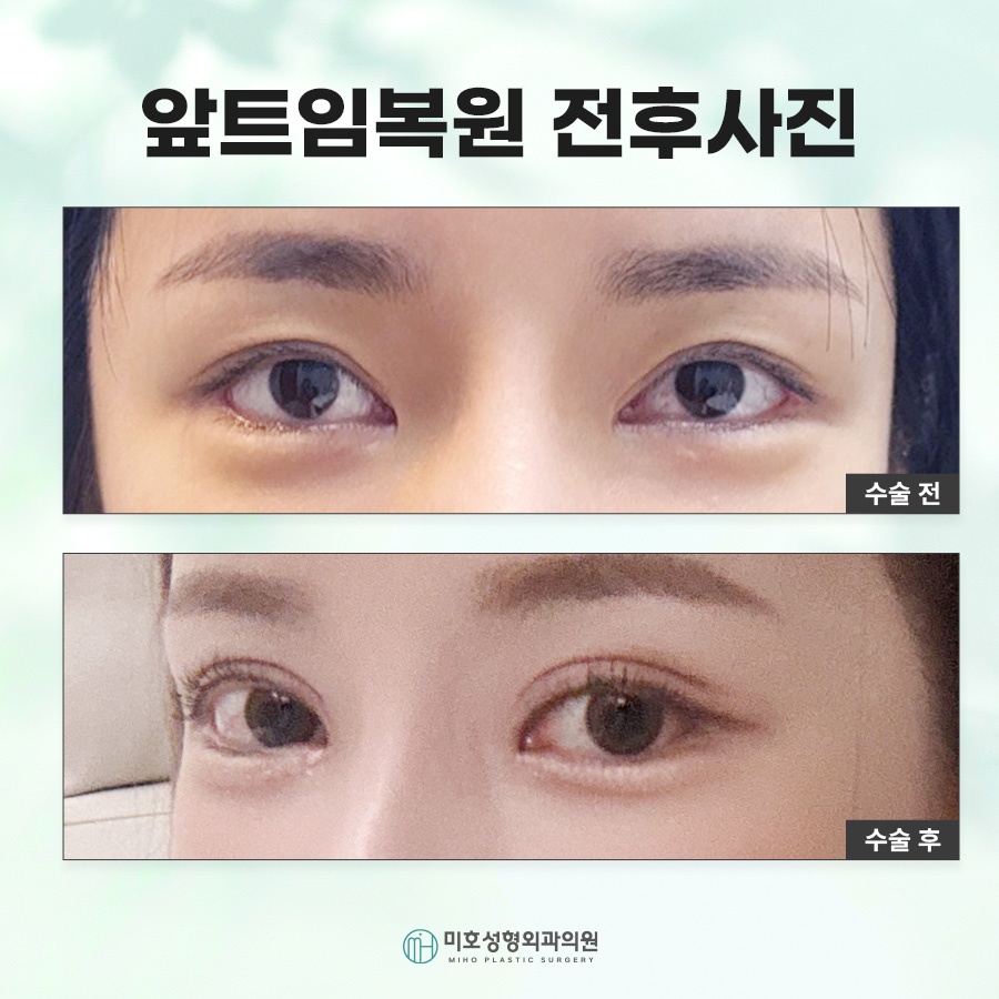 How Medial Canthoplasty Restoration Is Performed and Scar Care image 9