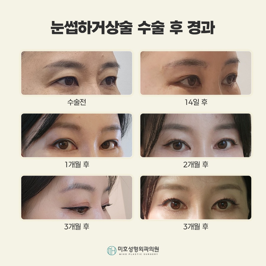 Sub-Brow Lift for Softening a Heavy Appearance image 6
