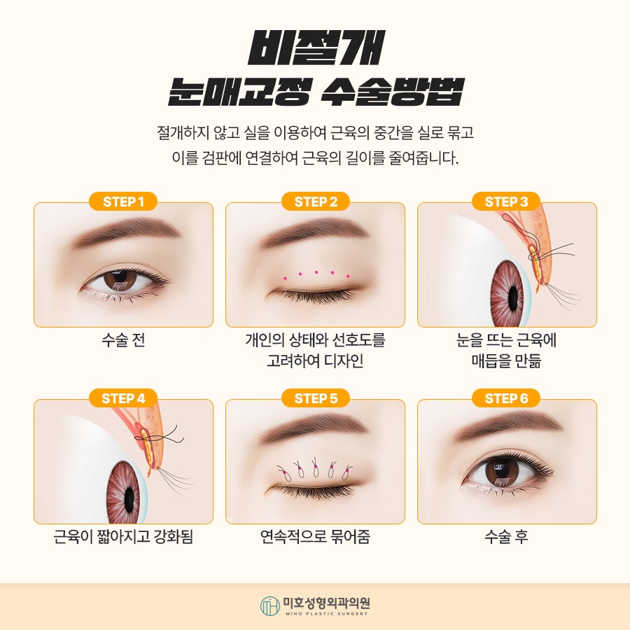 남자눈매교정 자연스러운 이미지로 관련 이미지 5
