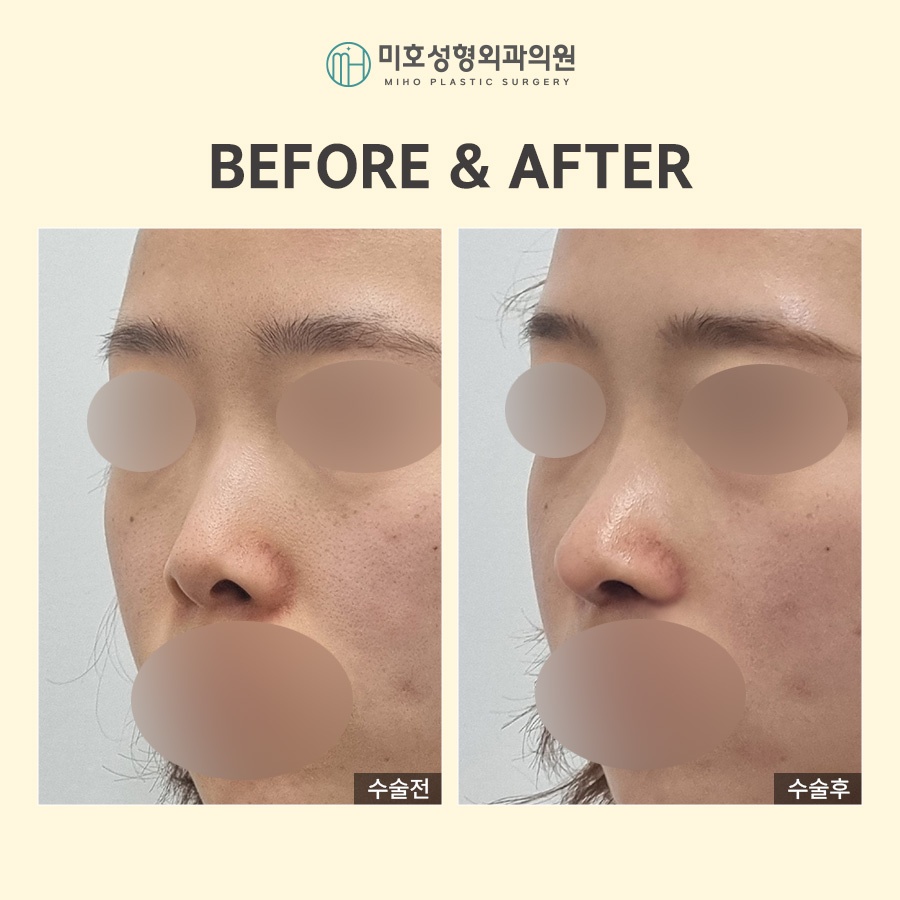 Adjusting the Approach According to the Type of Nostril-Lowering Procedure image 6