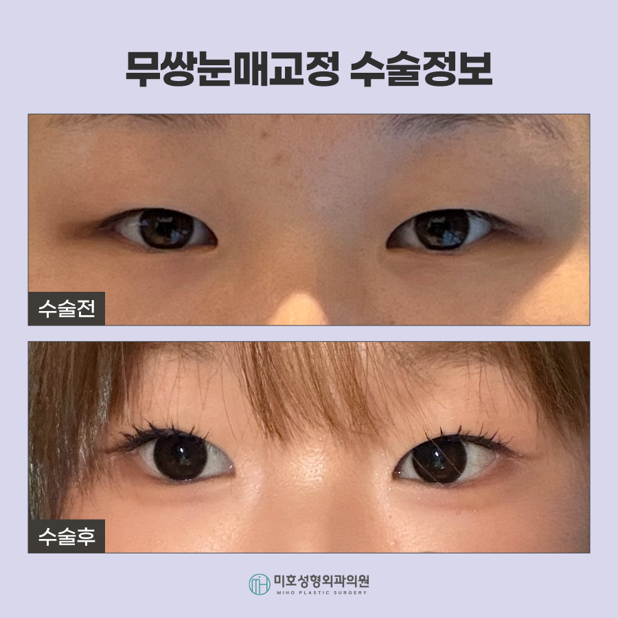 무쌍눈매교정 자연스러운 눈매 완성 관련 이미지 6