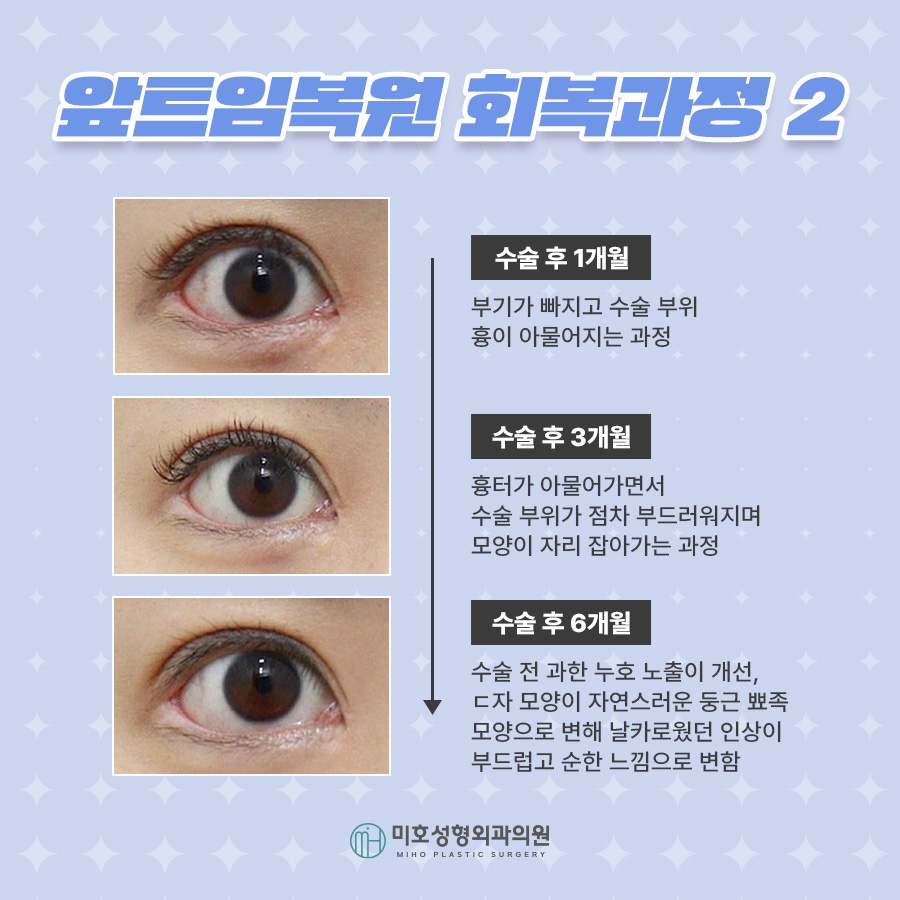 앞트임복원 제대로 알기 관련 이미지 7