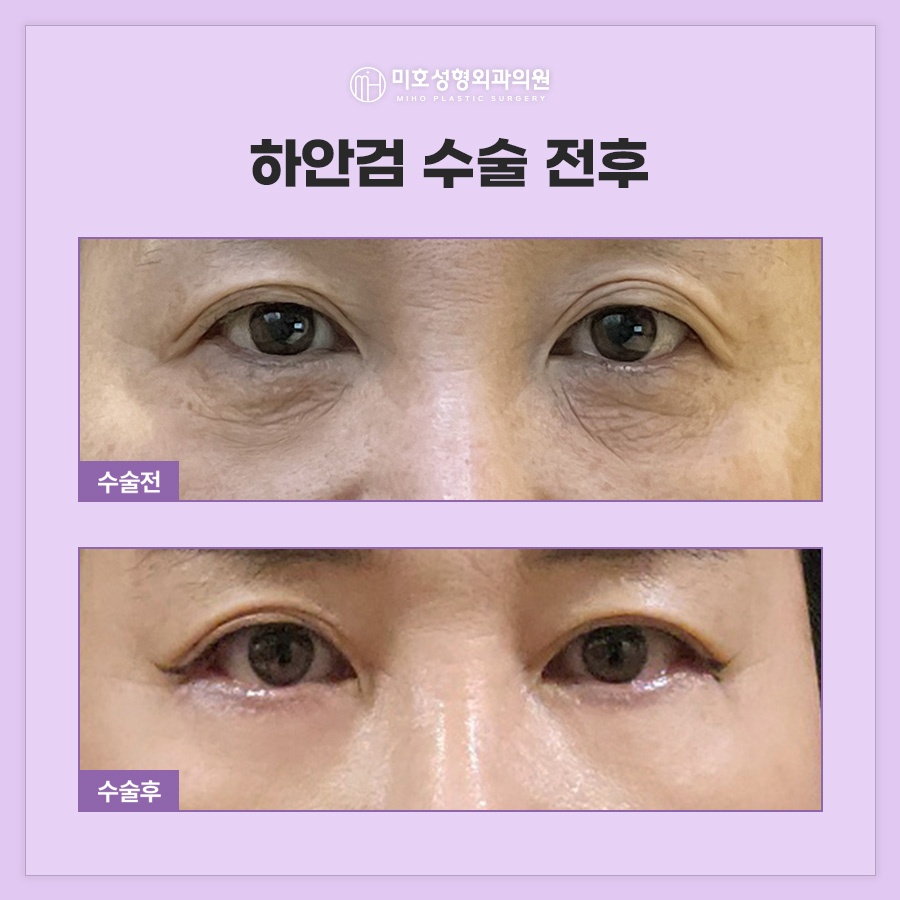 When Is Lateral Canthal Fixation Needed with Lower Blepharoplasty? image 10
