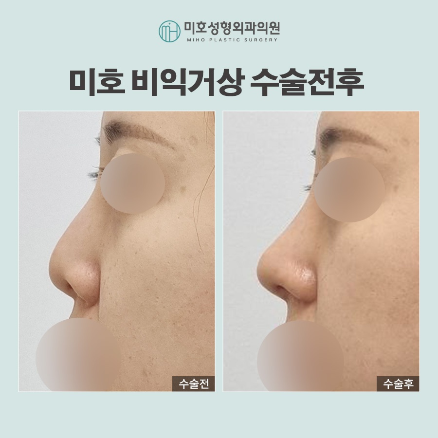 미호 비익거상 자연스러운 콧날개올리기 비율교정! 관련 이미지 7