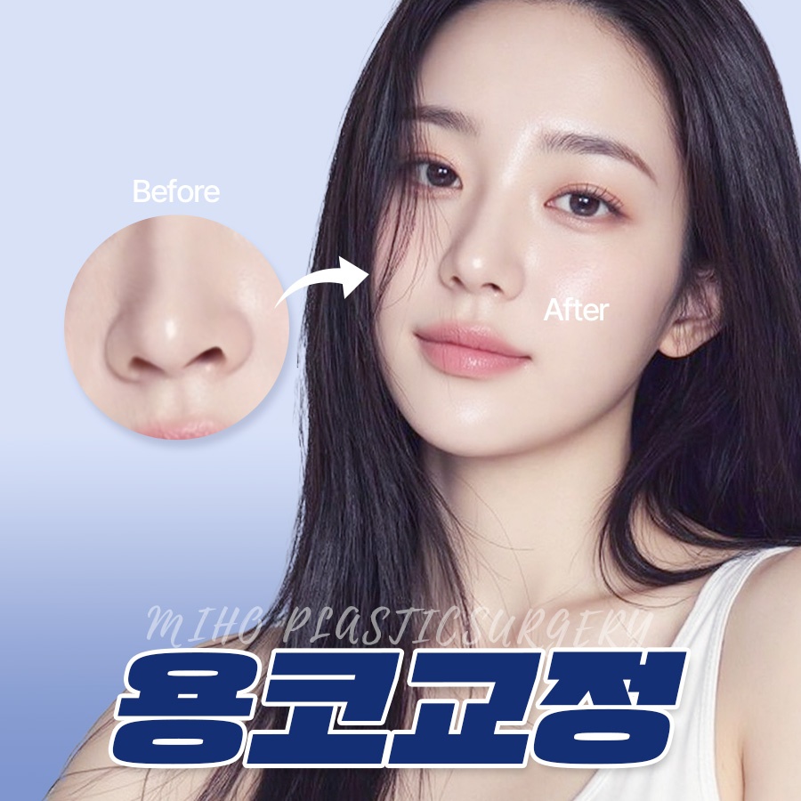 Correcting a Dragon Nose with Nostril-Lowering Surgery image 1