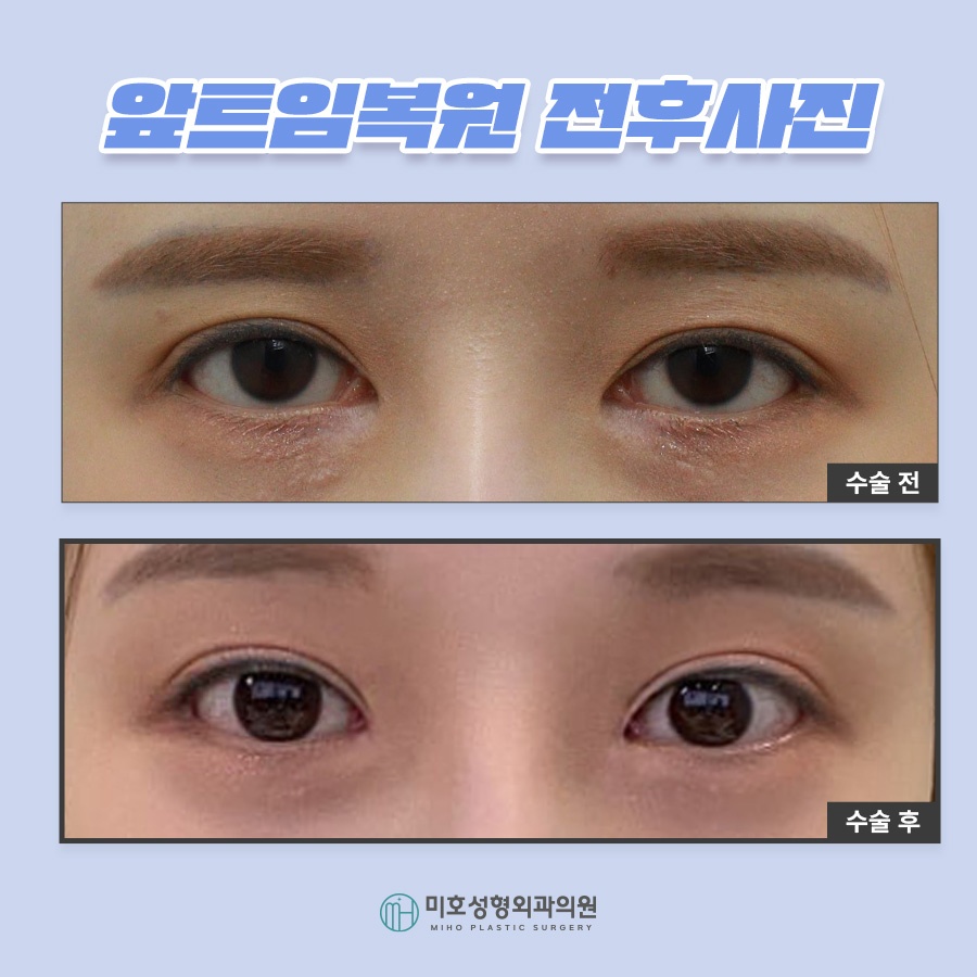앞트임복원 제대로 알기 관련 이미지 10