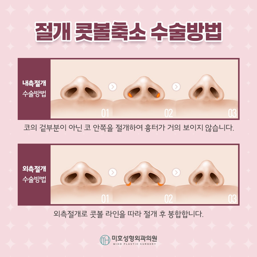 콧볼축소 자연스러운 결과로 관련 이미지 5