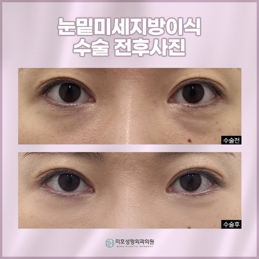 눈밑미세지방이식 올바른 계획으로 관련 이미지 9