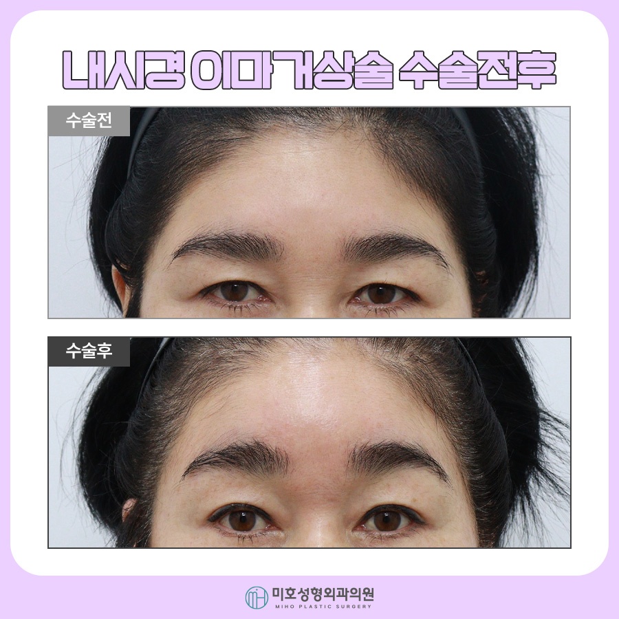 Why Choose Thread Lifting for a Brow Lift image 8