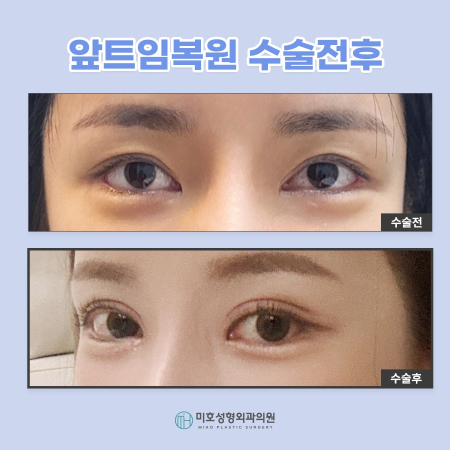 앞트임복원 및 라인 변화를 원한다면 관련 이미지 10