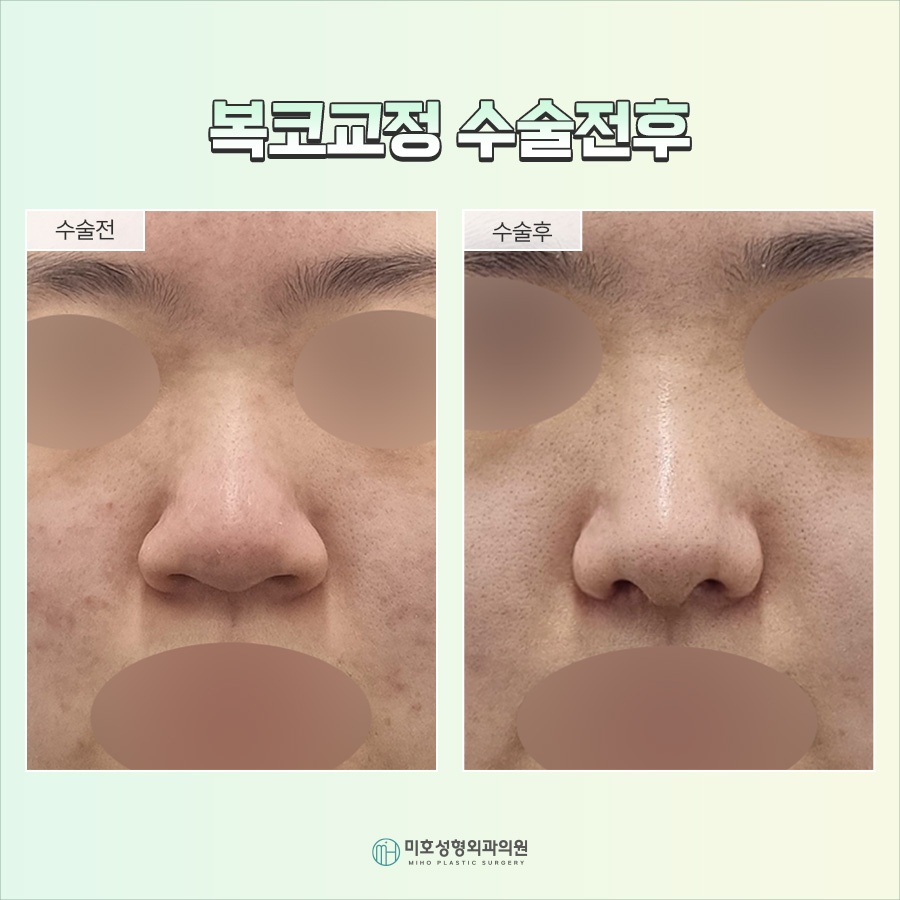 Nose Tip Refinement for a More Defined Impression image 8