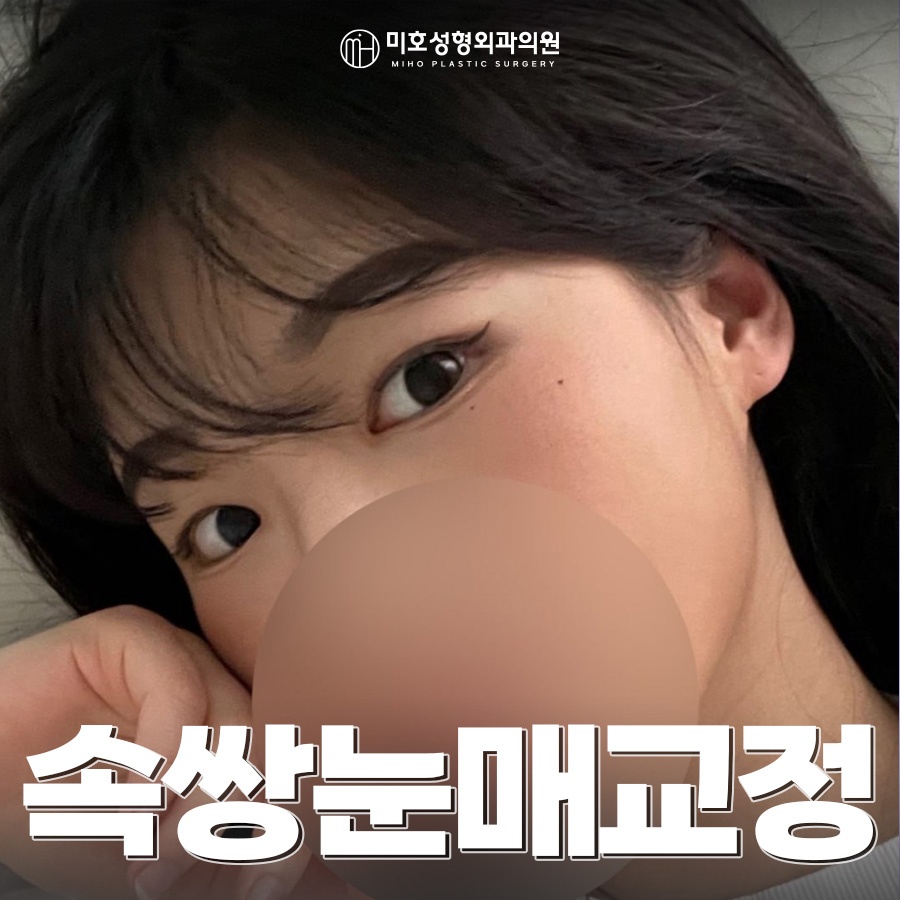 속쌍눈매교정에 관심을 두고 있다면 관련 이미지 1