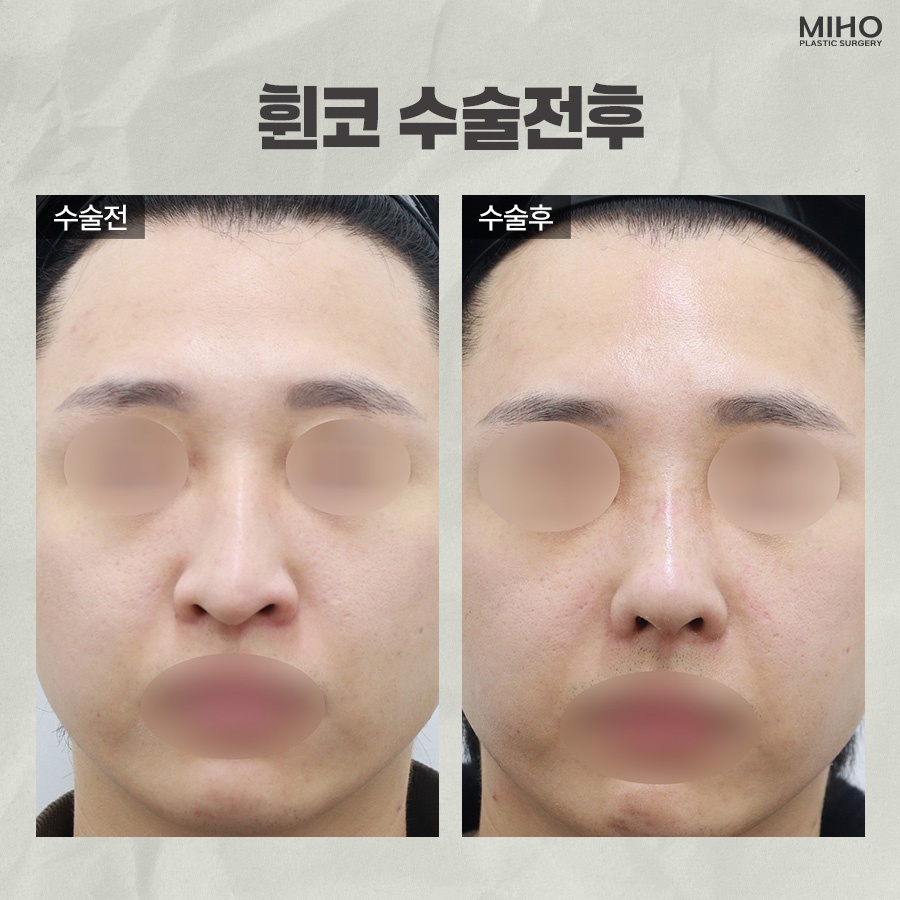 Experiencing the Difference in Crooked Nose Surgery image 11