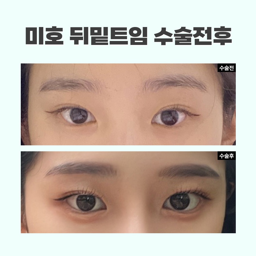 뒷트임밑트임후기 주의할 점 관련 이미지 6