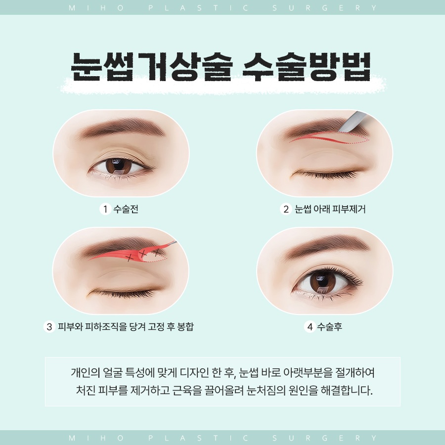 눈썹거상술 인위적이지 않은 변화 관련 이미지 5