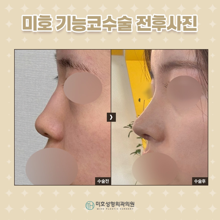 While Adjusting the Shape During Nasal Valve Reconstruction image 9