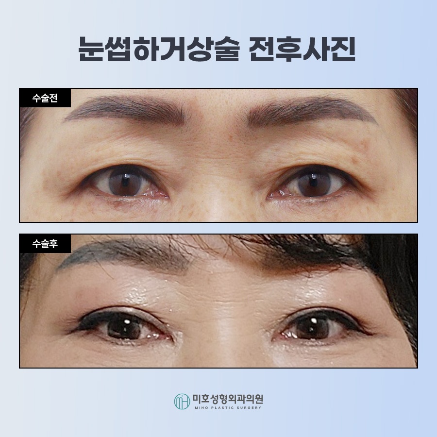 눈썹하거상술 처진 눈 개선 관련 이미지 8