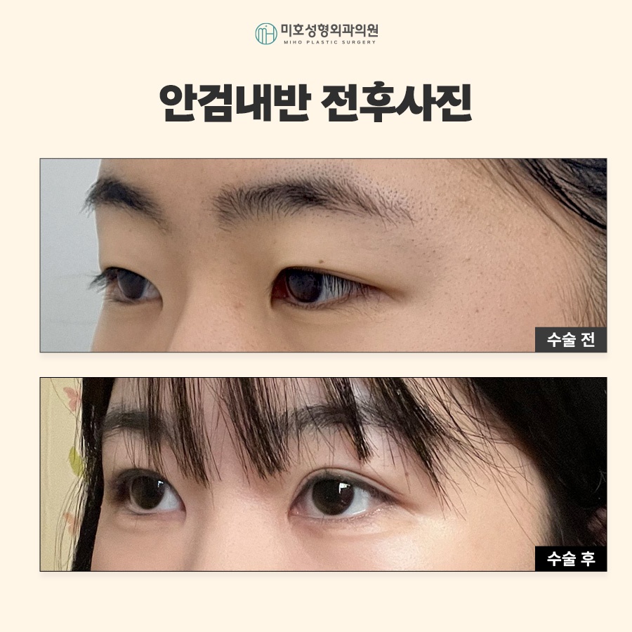 안검내반수술 눈물과 자극이 반복된다면 관련 이미지 9