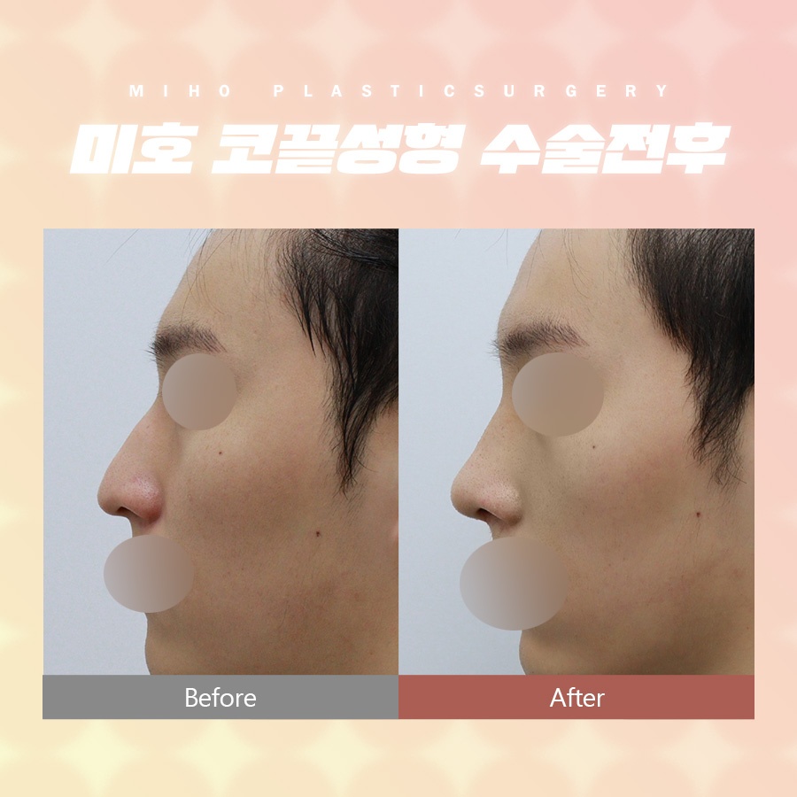 코끝성형 약간의 보완만으로 관련 이미지 8