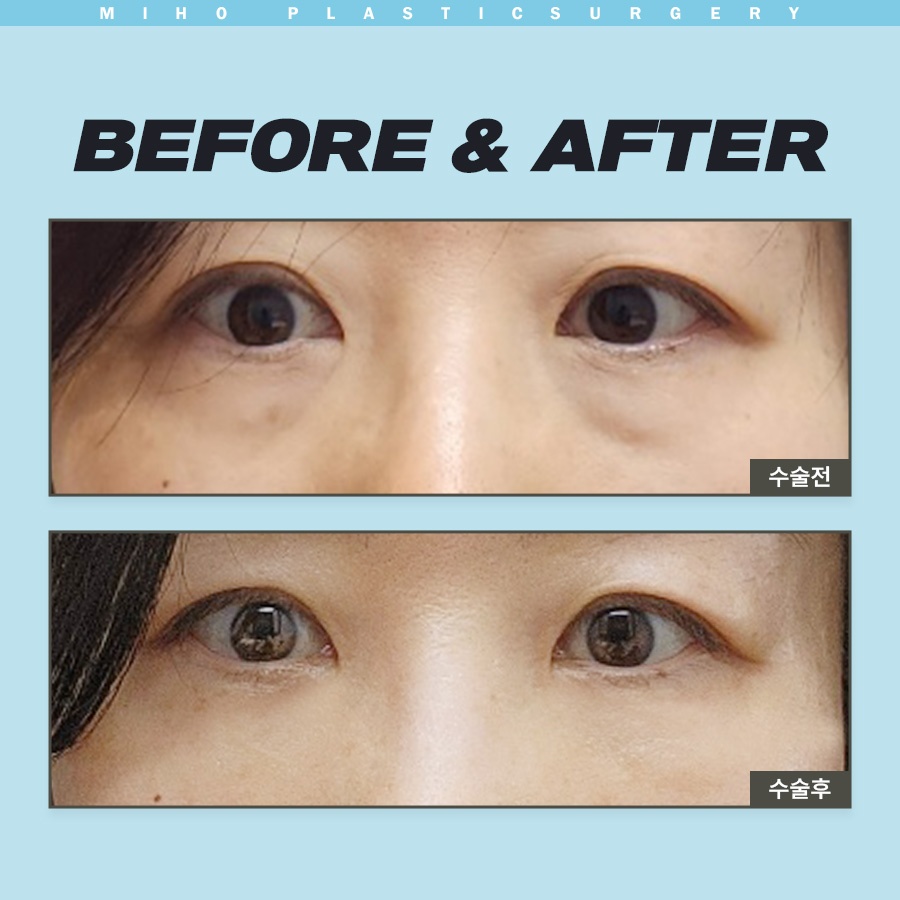 눈밑지방제거 하안검 다크써클 개선 방법 관련 이미지 8
