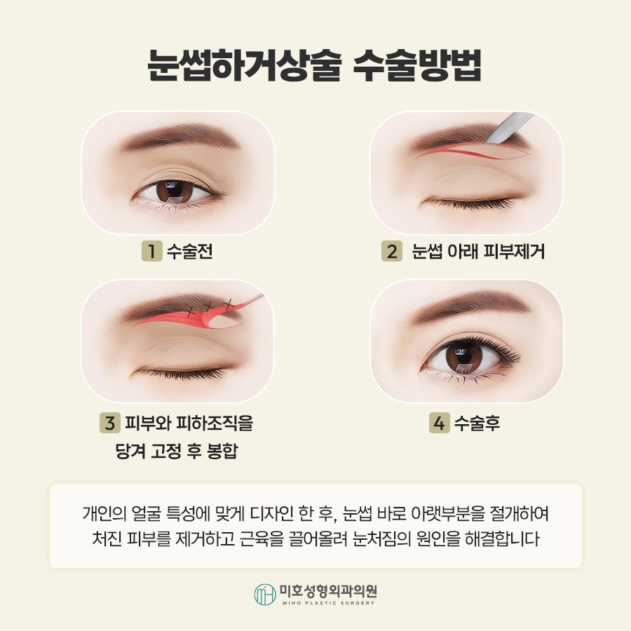 Sub-Brow Lift for Softening a Heavy Appearance image 5