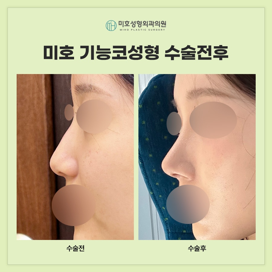 기능코 편안하고 아름다운 비결 관련 이미지 9