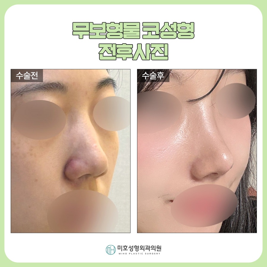 신논현코성형 선택시 고려할 부분들 관련 이미지 8