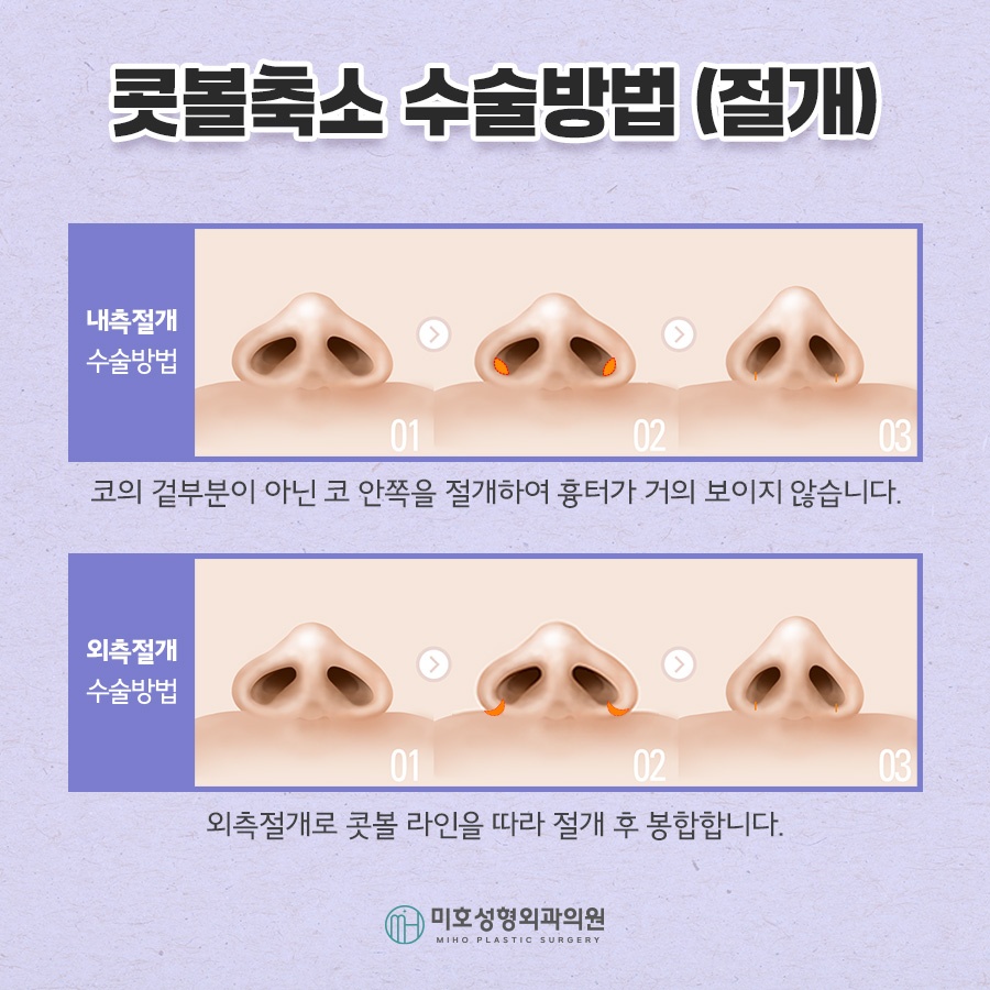 Refining Nostril Reduction in a Sophisticated Way image 5