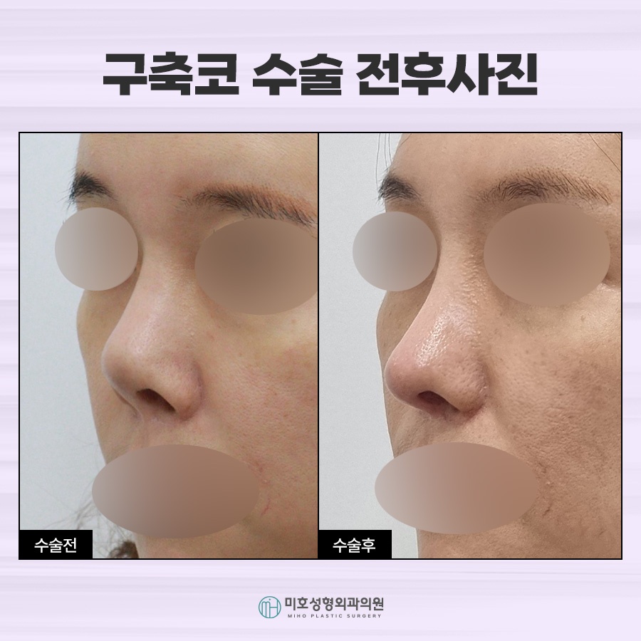 If You Need Contracted Nose Reconstruction image 8