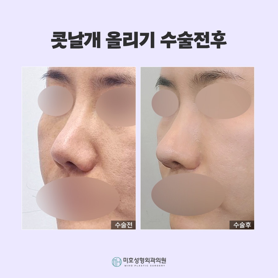 콧날개올리기 비익거상 기준 살펴보고 관련 이미지 9