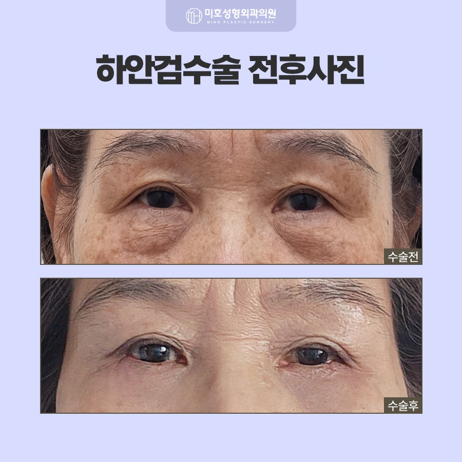 하안검수술 아래쪽 변화가 고민이라면 관련 이미지 8