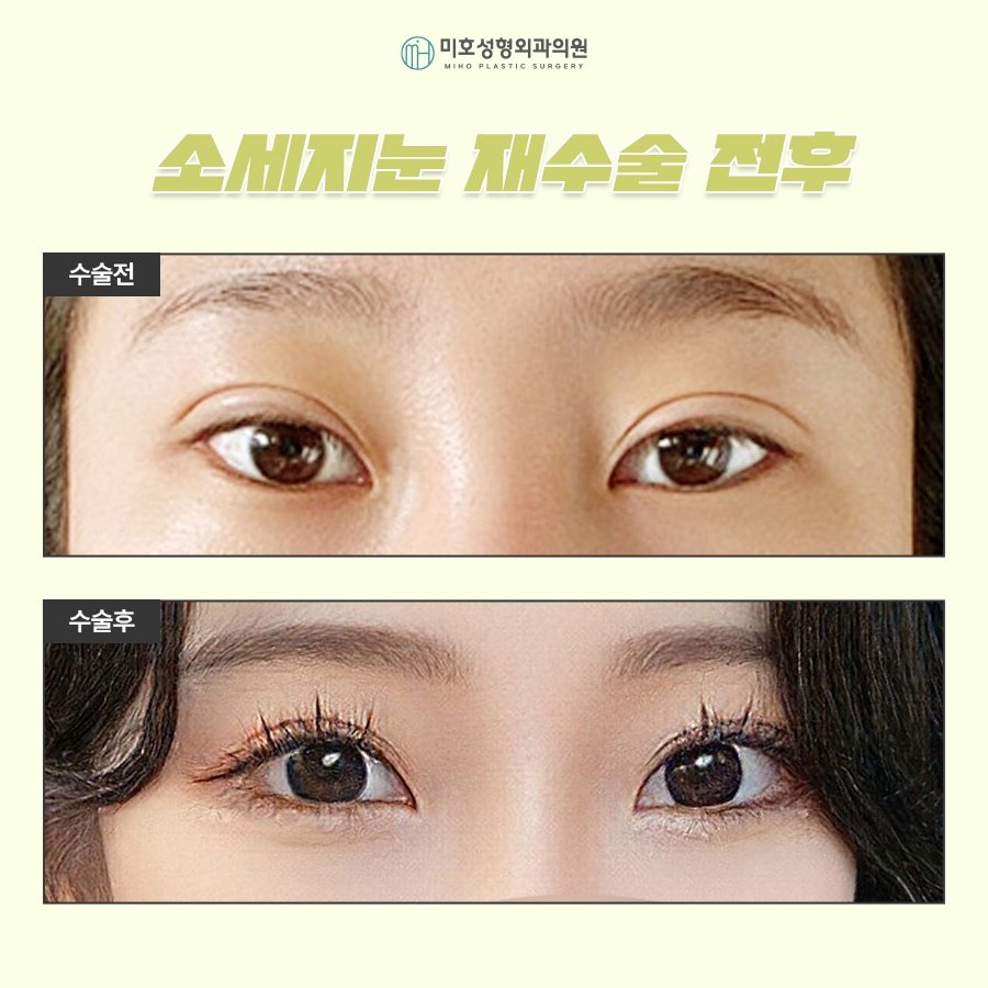 소세지눈재수술 고민된다면 관련 이미지 8