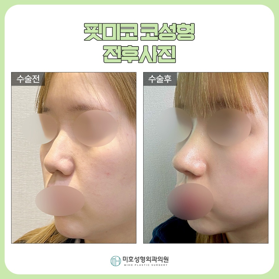 신논현코성형 선택시 고려할 부분들 관련 이미지 9