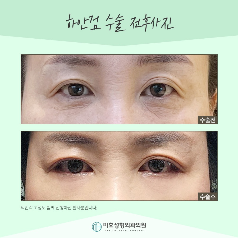 If Lower Blepharoplasty Is Needed for Drooping Eyes image 7