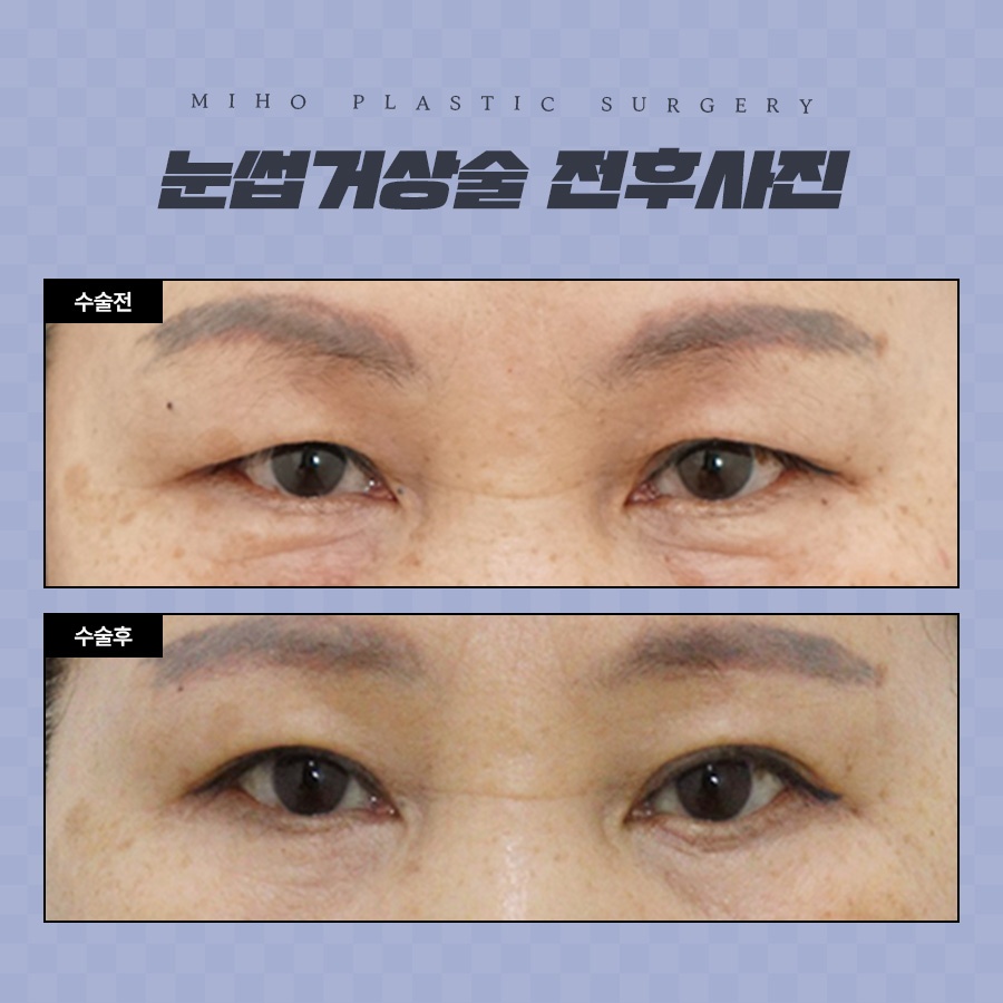 눈썹거상술 잘못된 오해와 장단점 관련 이미지 9