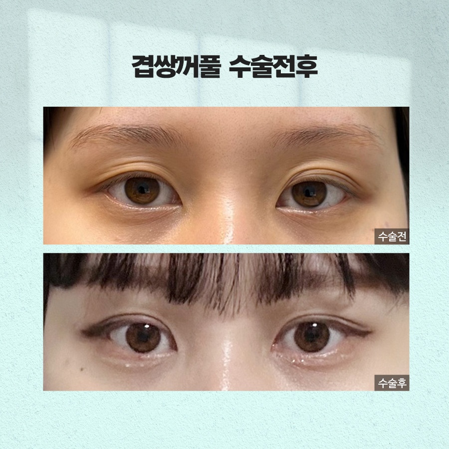 겹쌍꺼풀 생기는 이유와 없애는 방법까지 관련 이미지 8