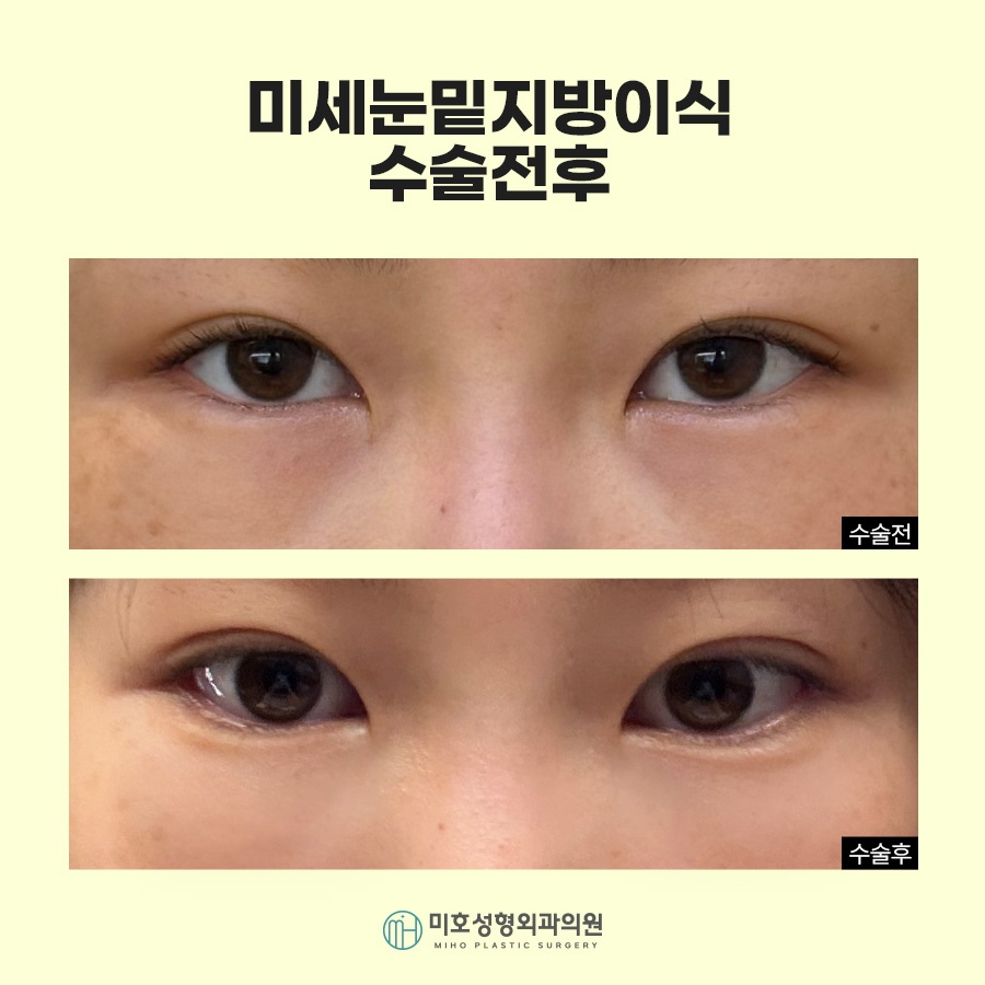 눈밑지방이식 자연스러운 입체감 완성 관련 이미지 9