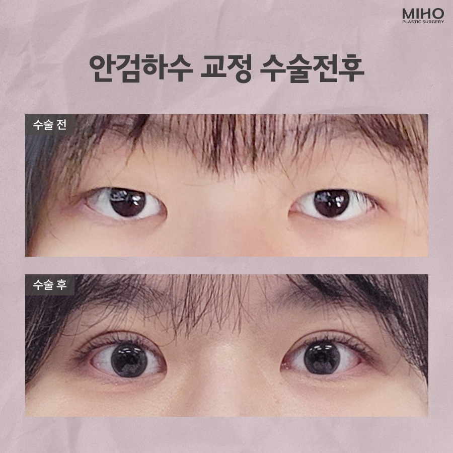 안검하수 발생 요인과 증상에 맞춰 관련 이미지 9