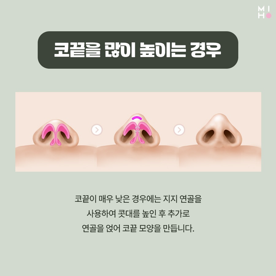 코끝연골묶기 복코 교정을 위한 과정 관련 이미지 7