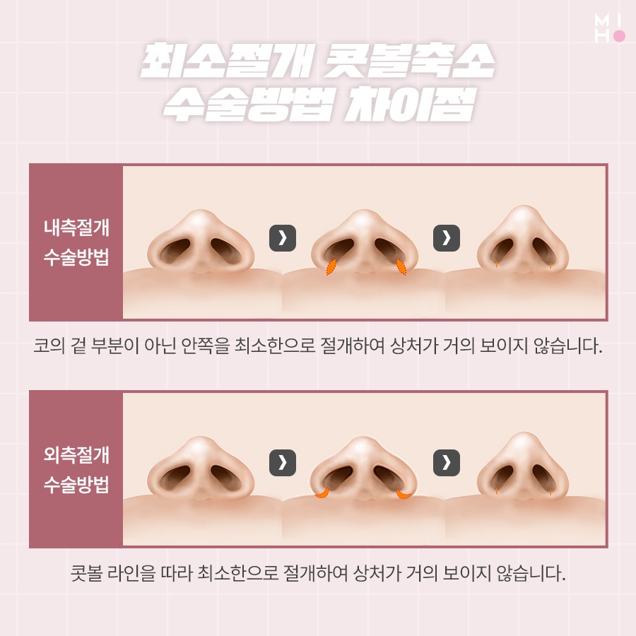 콧볼축소수술 나에게 적합한 방식으로 관련 이미지 4