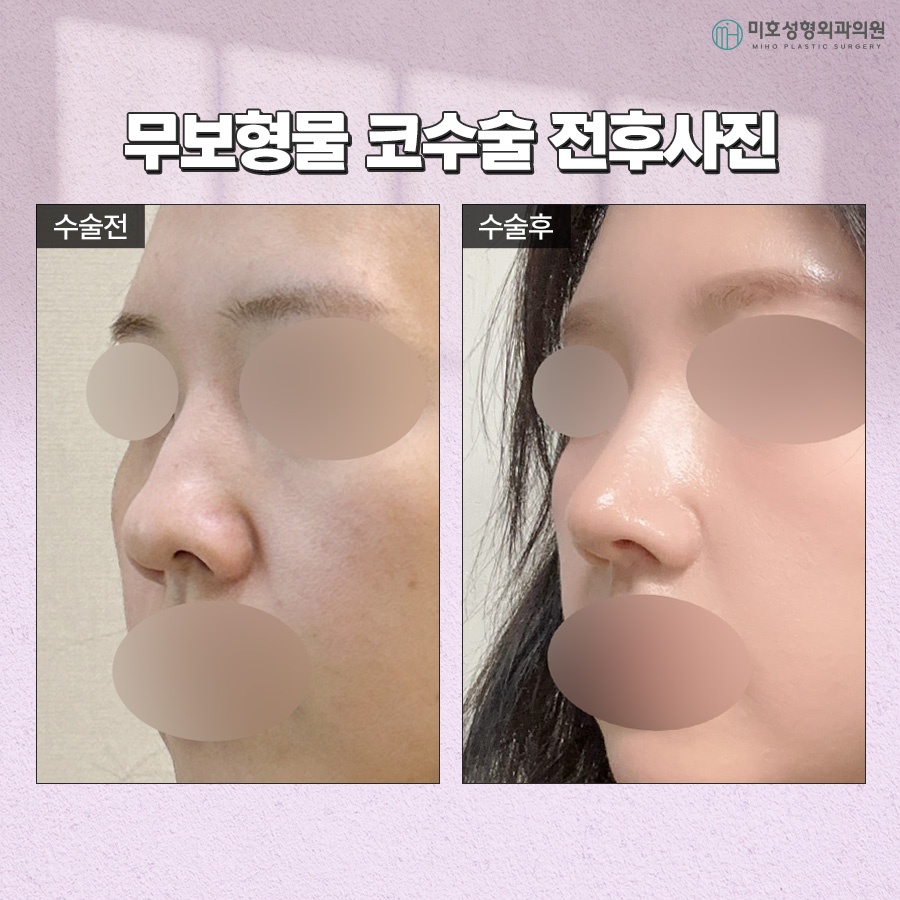 Criteria for Choosing Natural-Looking Implant-Free Rhinoplasty image 9