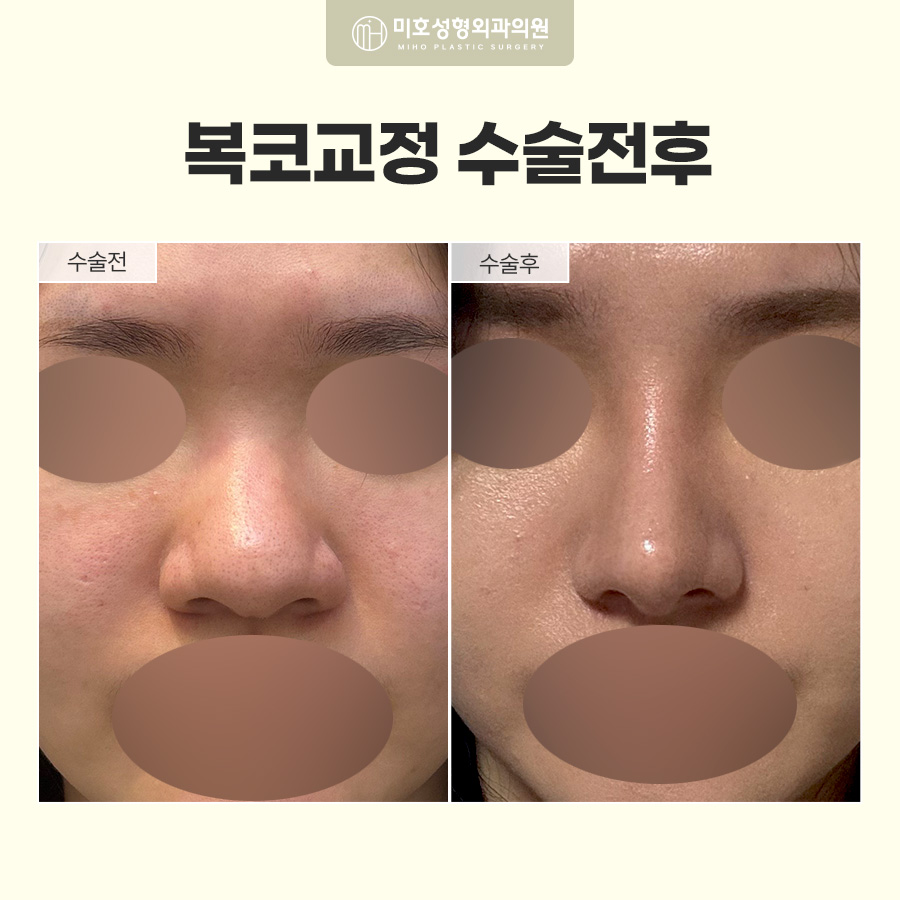 복코교정이란? 복코 원인부터 수술방법, 회복기간까지 알아보기 관련 이미지 8