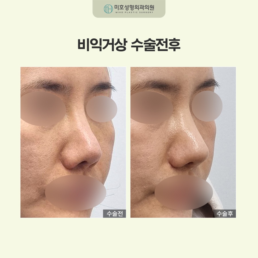 비익거상으로 예쁜 코 만드는 비결 총정리 관련 이미지 7