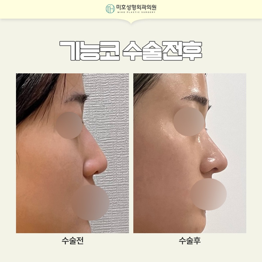 If You're Curious About Who Is Recommended for Nasal Valve Reconstruction and the Recovery Period image 8